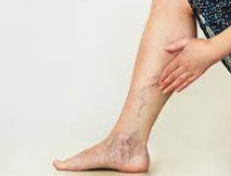 3 How to treat varicose veins You can do it by yourself easily